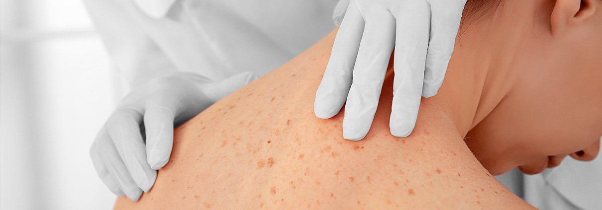 Tipos de Cáncer de Piel