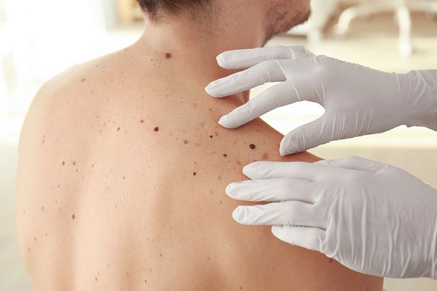 ABCDE del melanoma