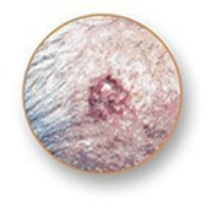 Carcinoma basocelular