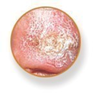 Carcinoma espinocelular